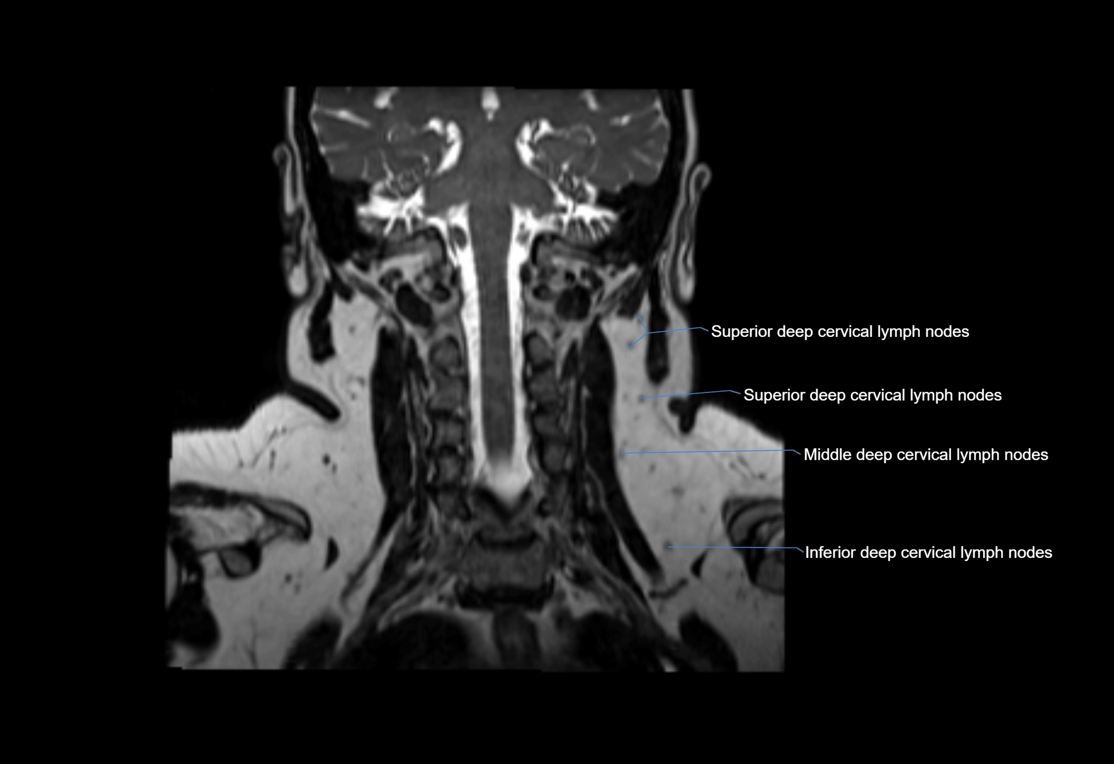 Neck coronal lymph node cross sectional MRI anatomy 3T MRI  image-img-00001-00024.webp